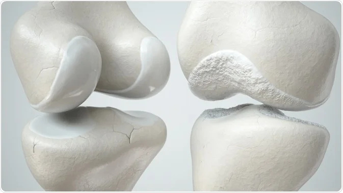 osteoarthritis Το καλύτερο Φάρμακο για Οστεοαρθρίτιδα
